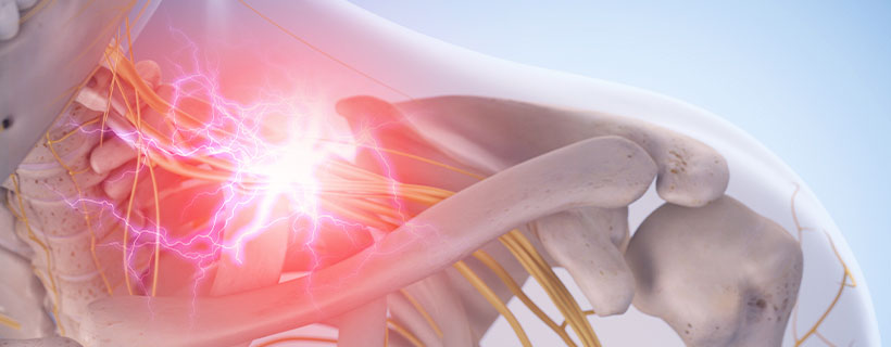 patient needing brachial plexus neuritis treatment in Lawrenceville